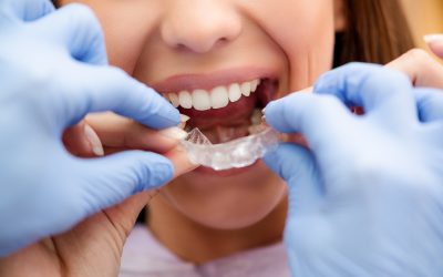 10 interesting facts about Invisalign