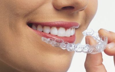 Advantages of Invisalign over Braces