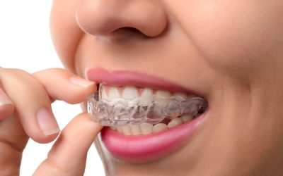 5 Myths about Invisalign you should overcome TODAY