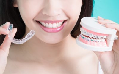 5 key factors to compare between braces and Invisalign