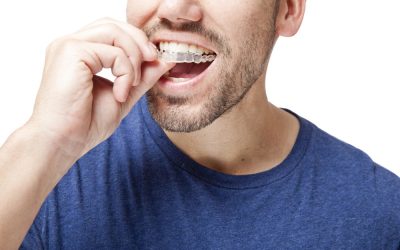 Benefits of Invisalign