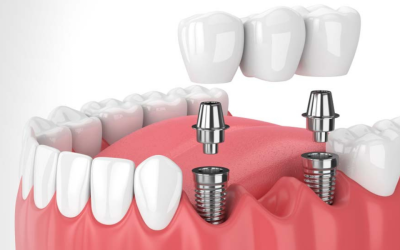 Dental Implants: Welcome a Toothy Smile!