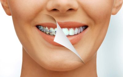 How do braces work to straighten your teeth?