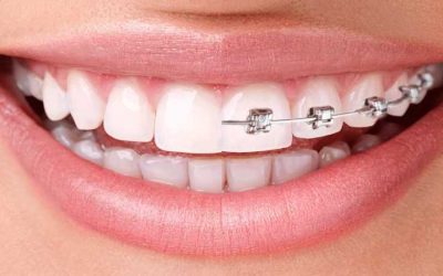 Invisalign VS Braces – What are the benefits