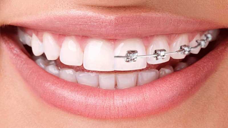 Invisalign VS Braces - What are the benefits - Dr. Kishor's Dentistry