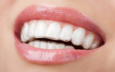 Pros and cons of Invisalign