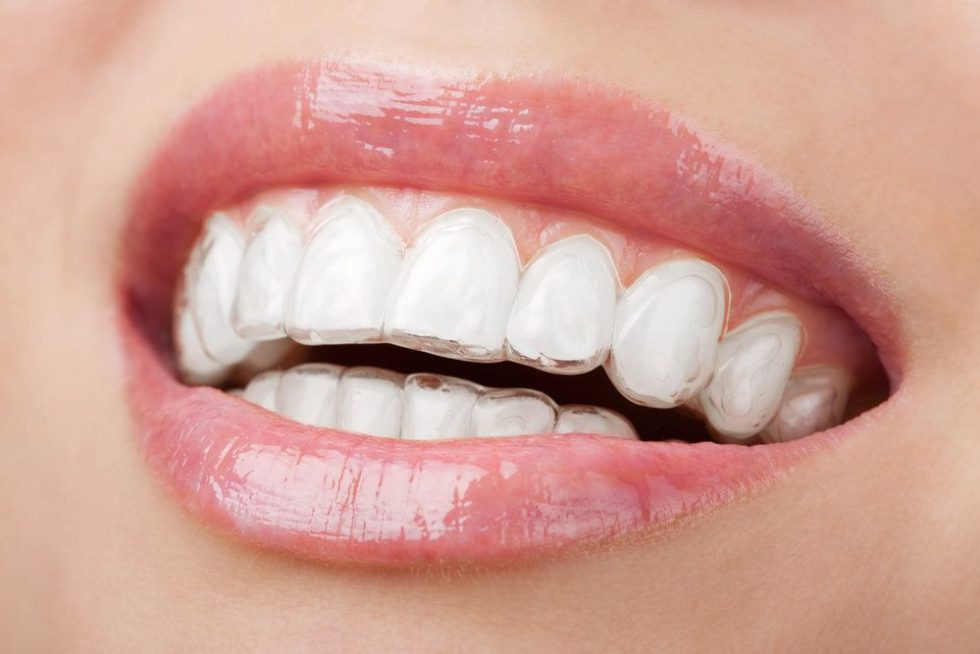 Pros And Cons Of Invisalign Dr Kishors Dentistry