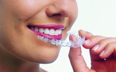 Pros and Cons of Invisalign Braces