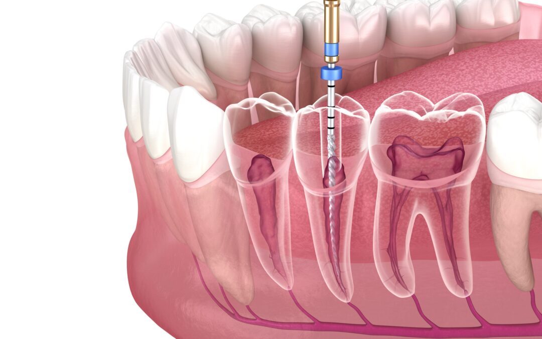 What is Rootcanal?
