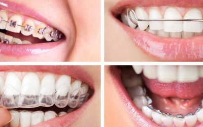 What are the different types of braces and which is right for me?