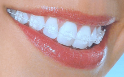 Why choose invisible braces over traditional braces?