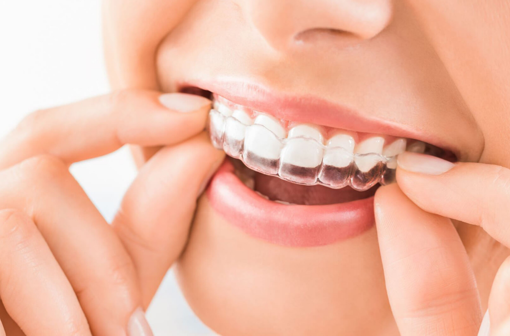 Invisalign: What you need for a glowing smile