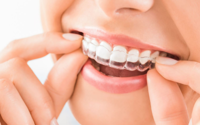 Invisalign: What you need for a glowing smile