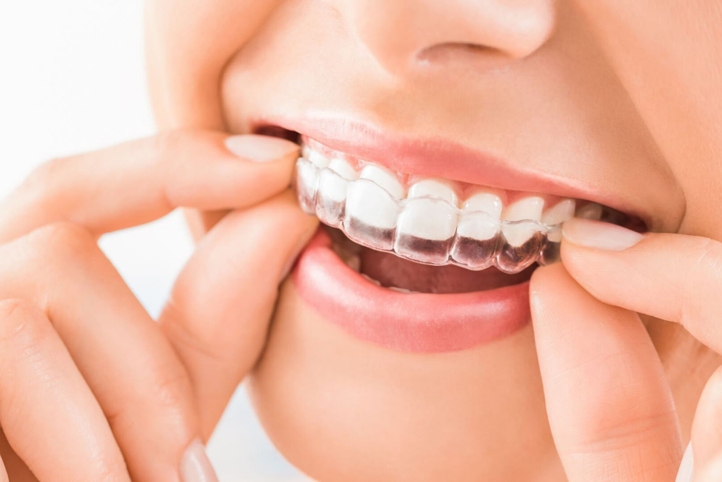 Invisalign VS Braces - What are the benefits - Dr. Kishor's Dentistry