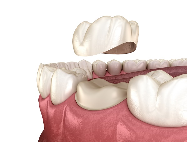 Dental crowns