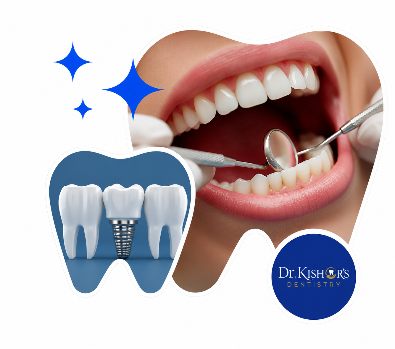 Dental Implant Treatment