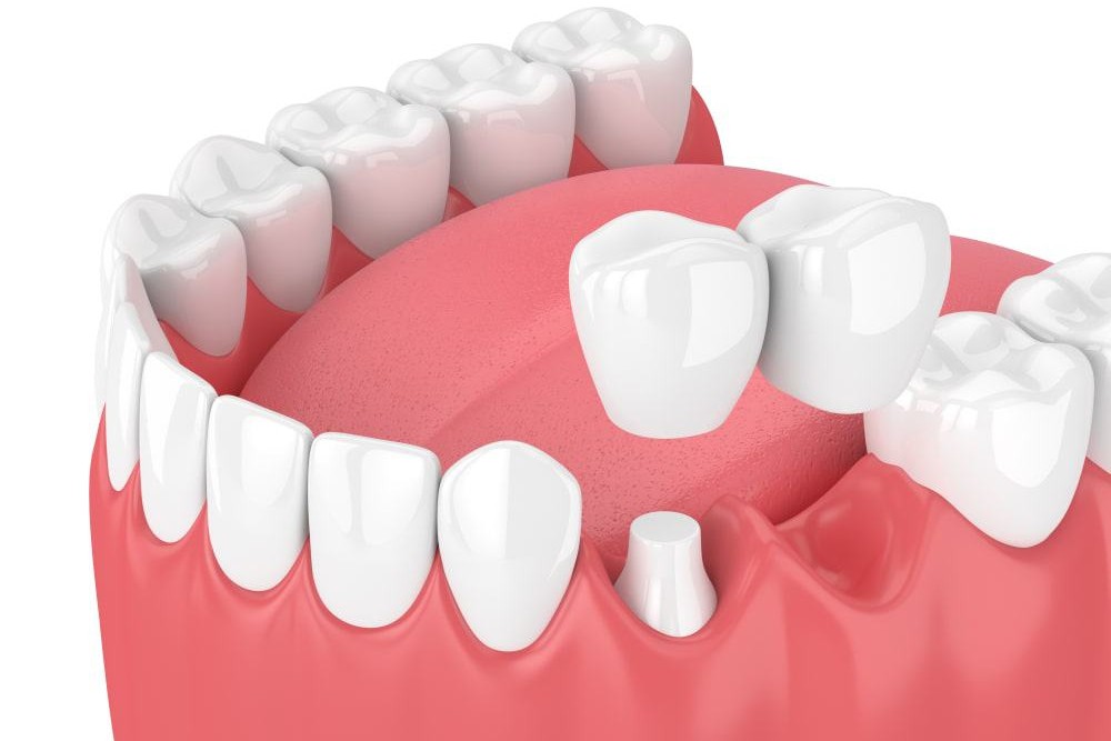 Partial Dentures