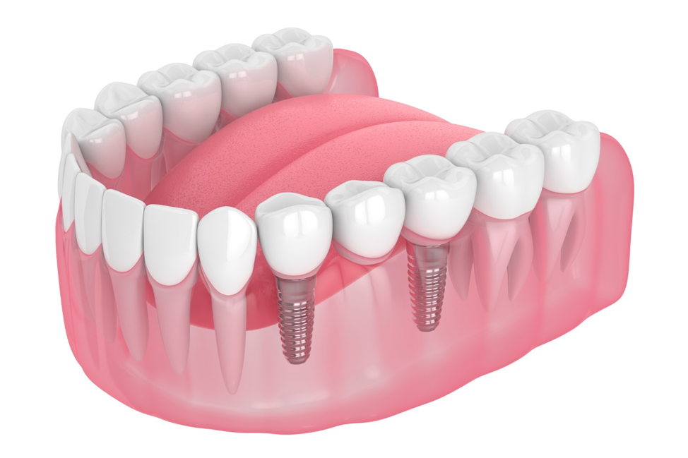 Implant-Supported Dentures
