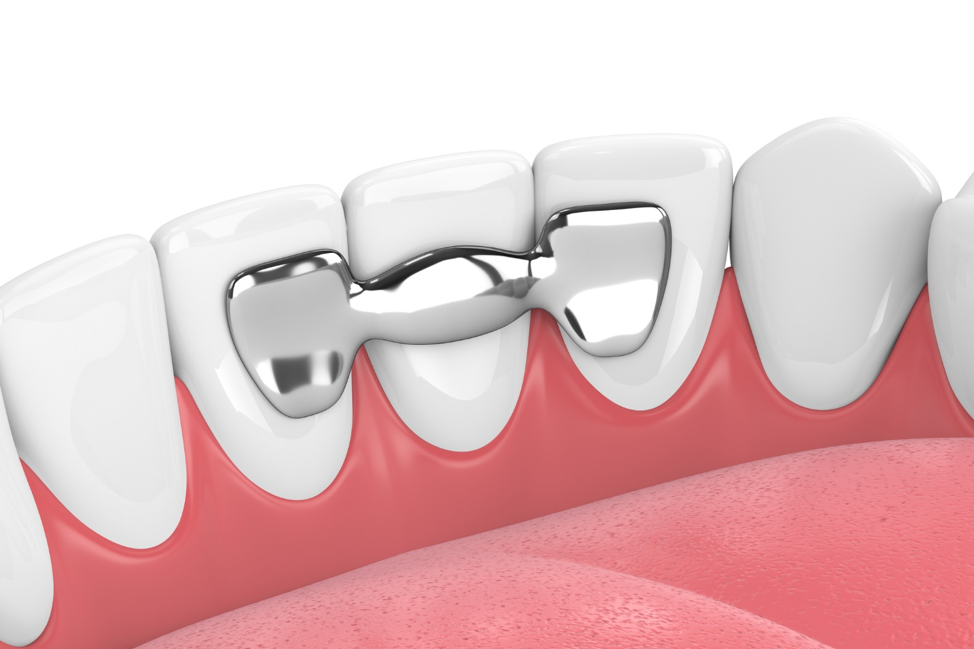 Flexible Dentures