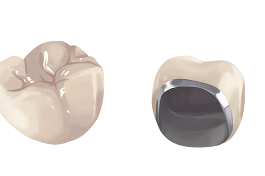 Flexible Dentures