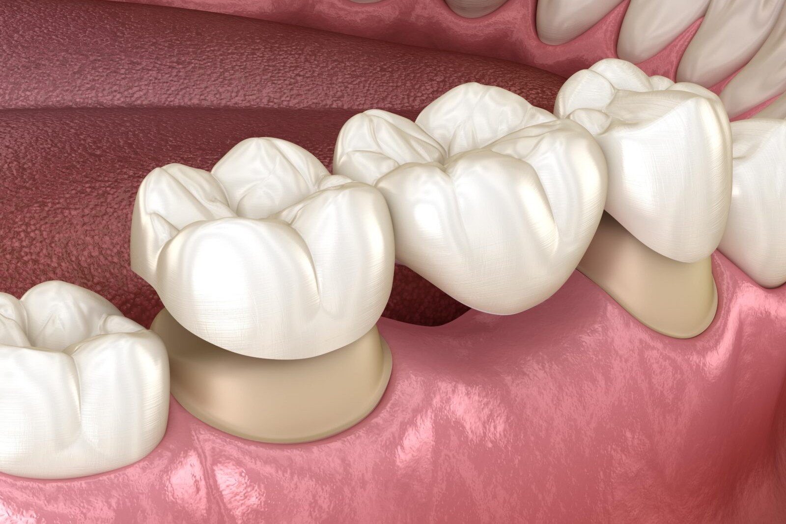 Complete Denture