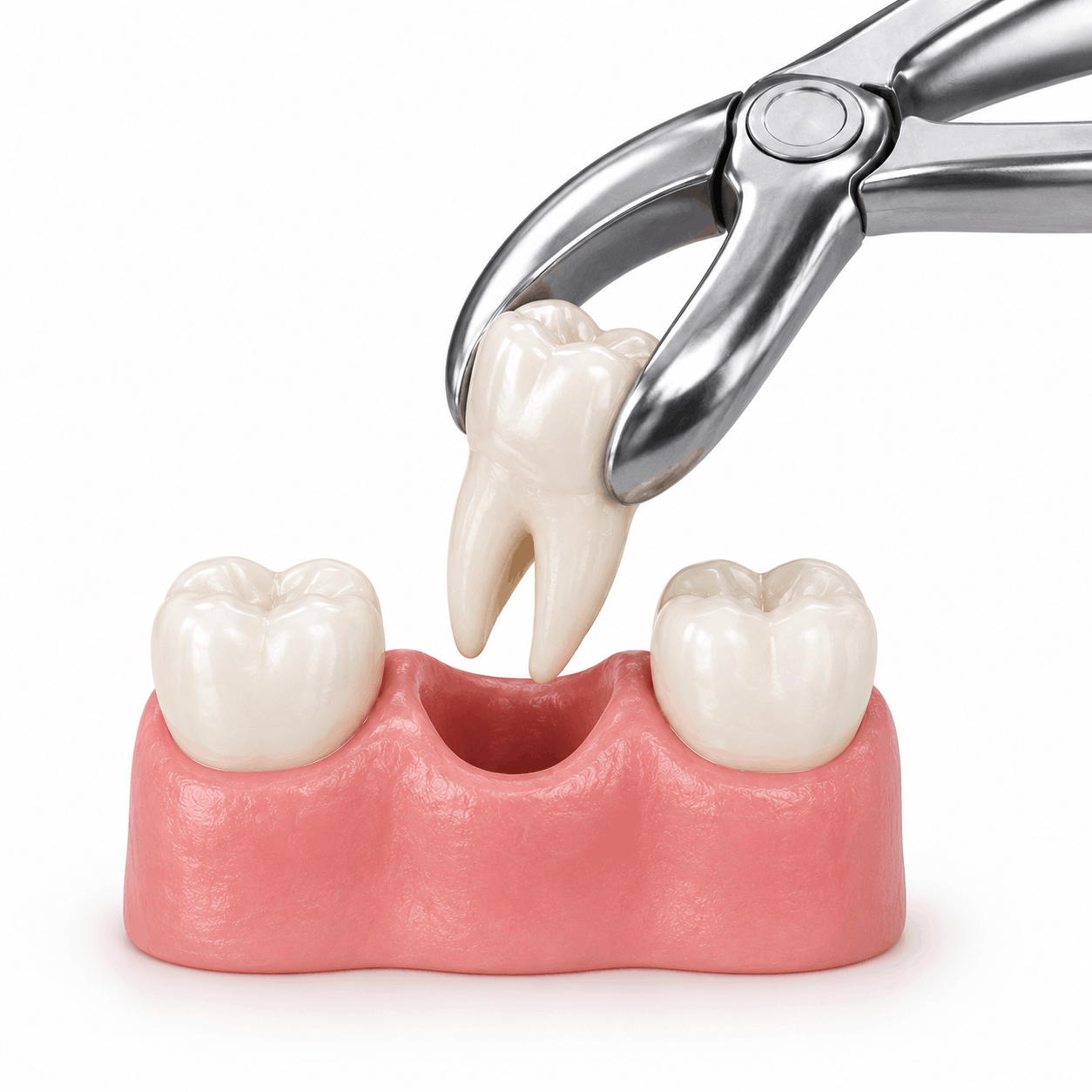 Tooth extraction
