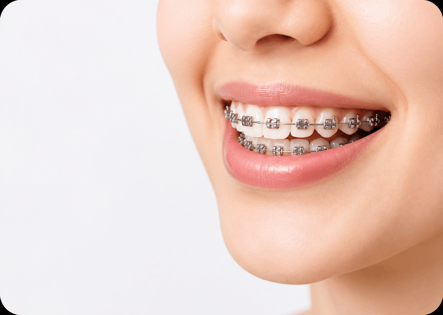 Dental braces treatment
