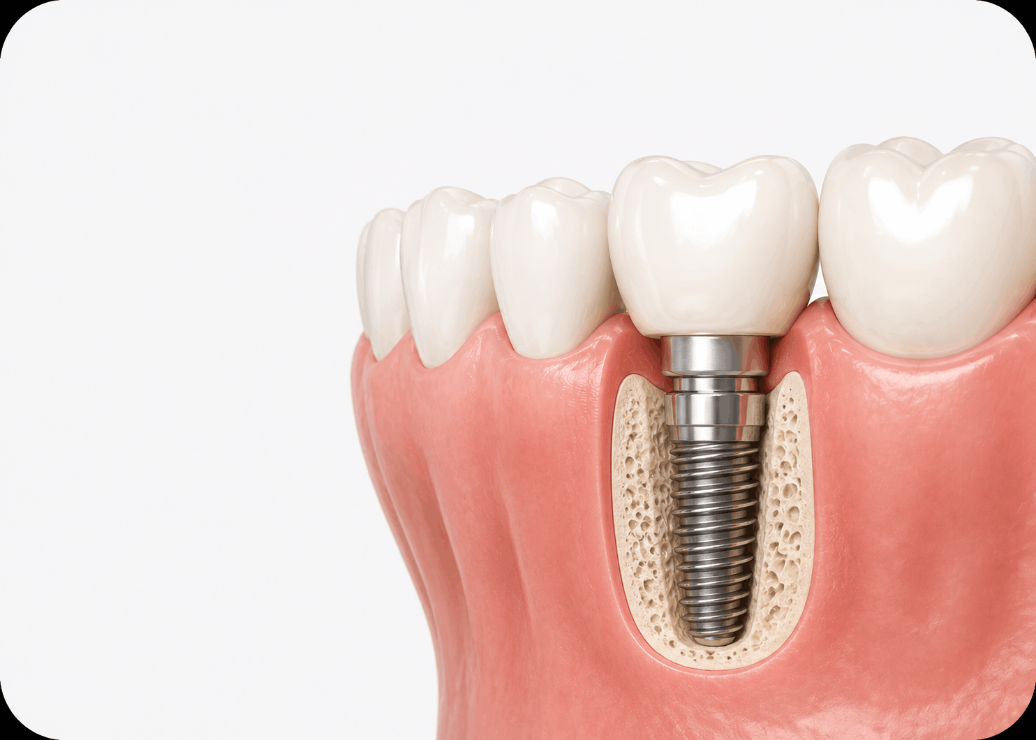 Dental implants