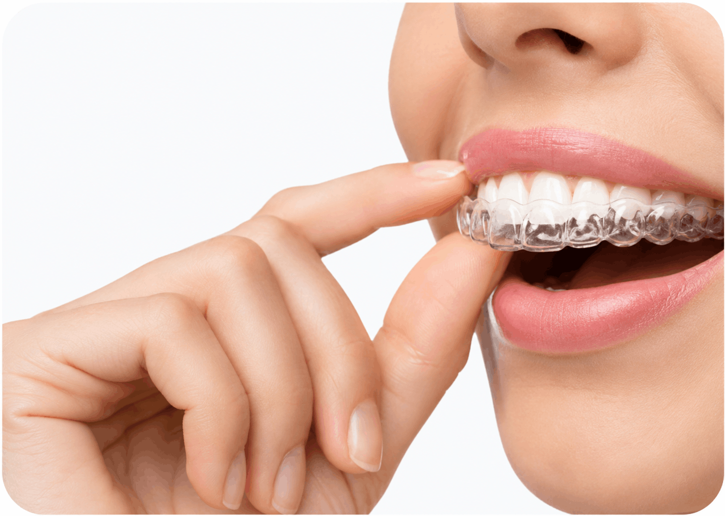 Invisalign clear aligners