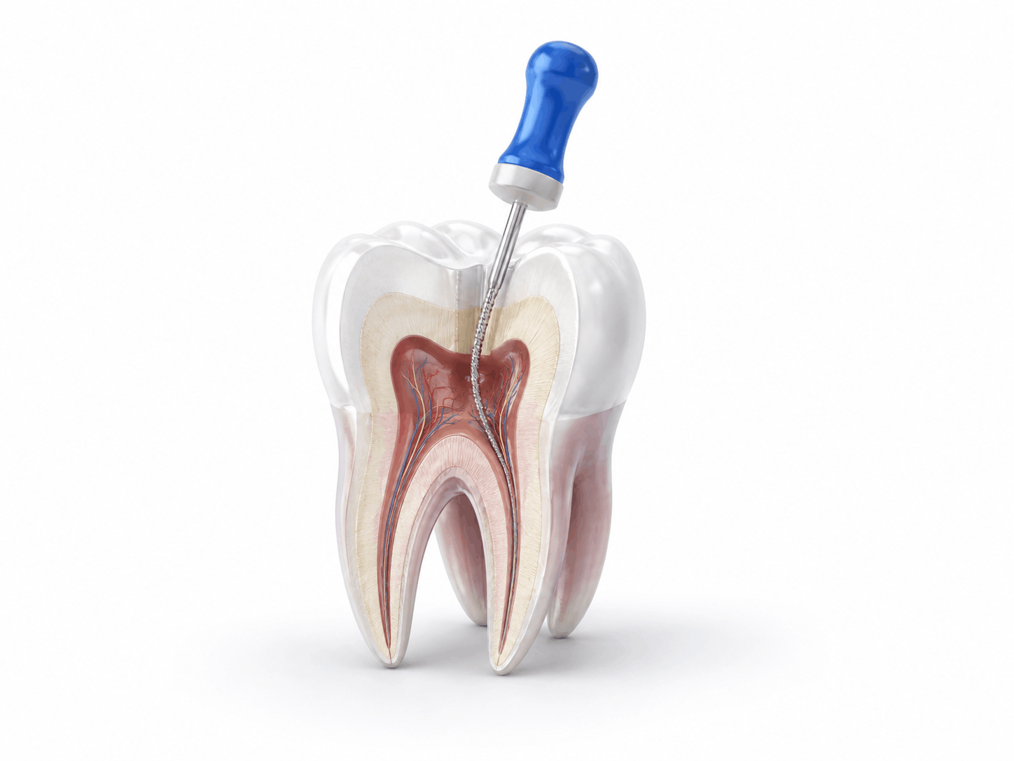 Root canal treatment